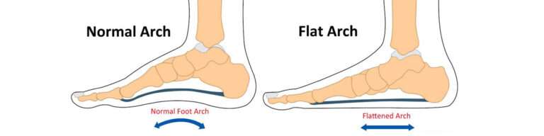 Pes Planus Flat Feet - Boyner Clinic