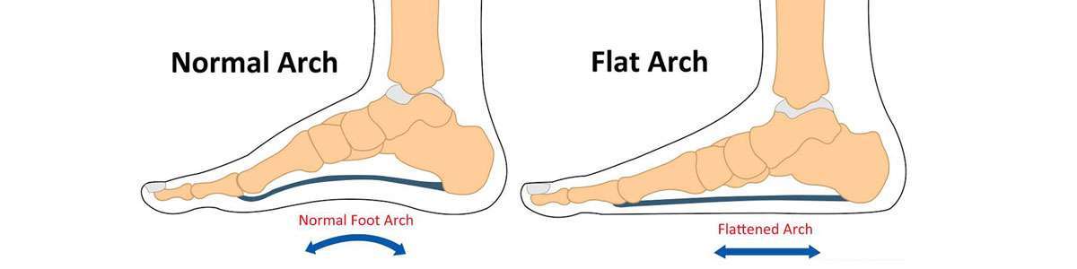 Pes clearance planus insoles