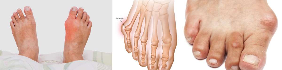 Bunion - deformity of the big toe