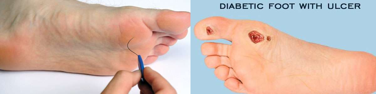 Diabetic Foot Care Center in Delhi