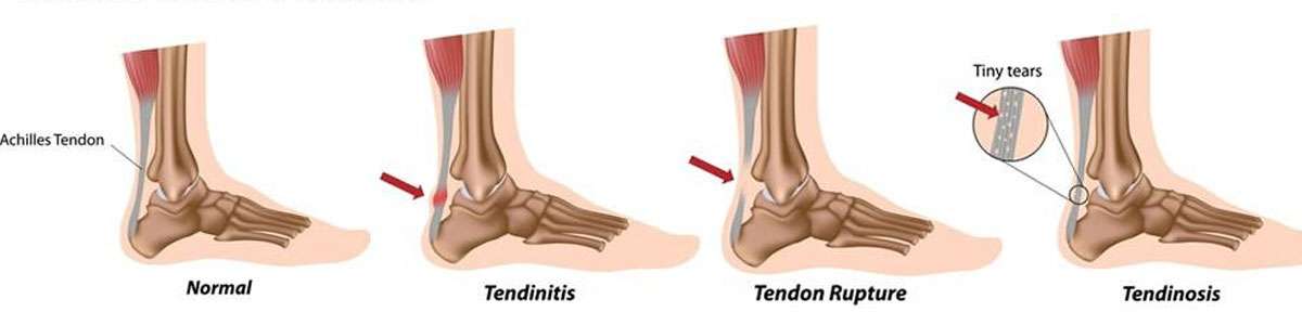 Pain under achilles on sale tendon