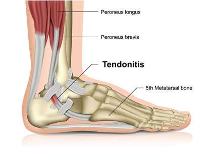 Peroneal Tendonitis disorders