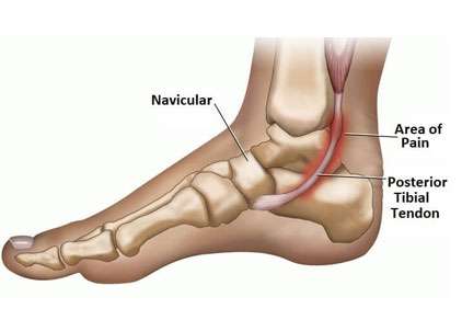 Tendinopathy foot condition