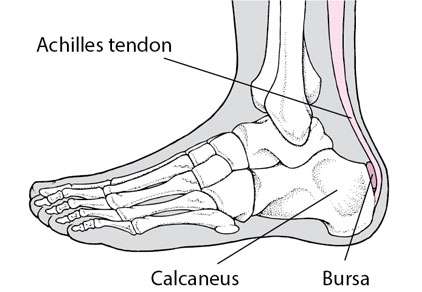 Achilles Tendonitis foot disease