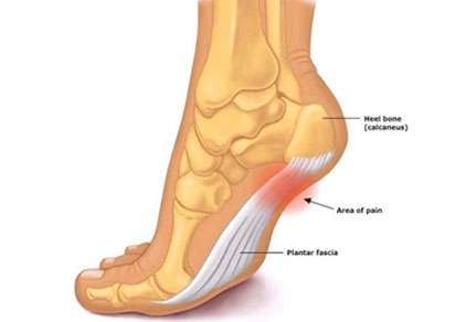 Plantar Fasciitis foot condition