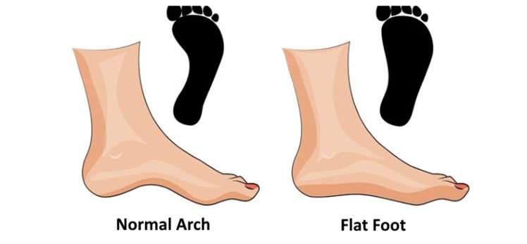 Normal Arch vs Flat foot