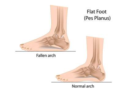 Pes Planus - Flat Feet