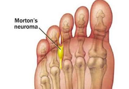 Mortons Neuroma foot condition