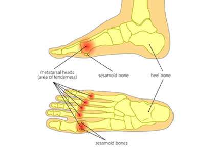 painful and inflamed foot condition