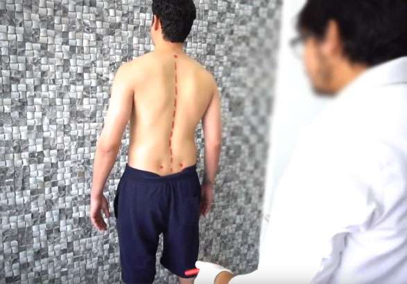 posture correction analysis