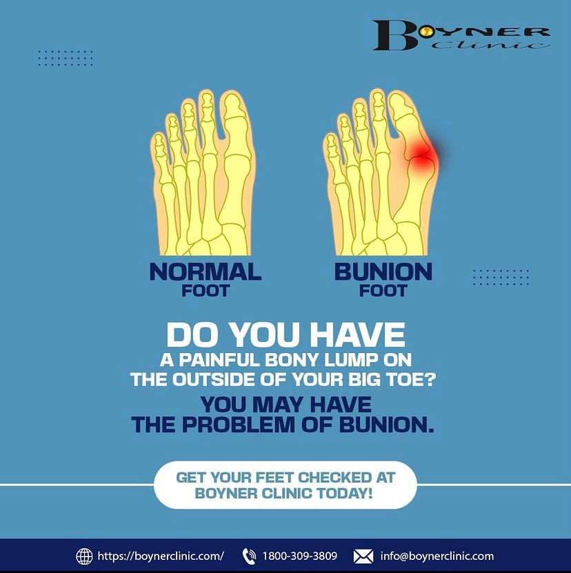 Normal foot vs Bunion Foot